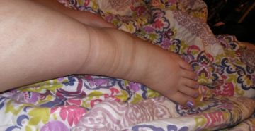 39 неделя беременности отекли ноги