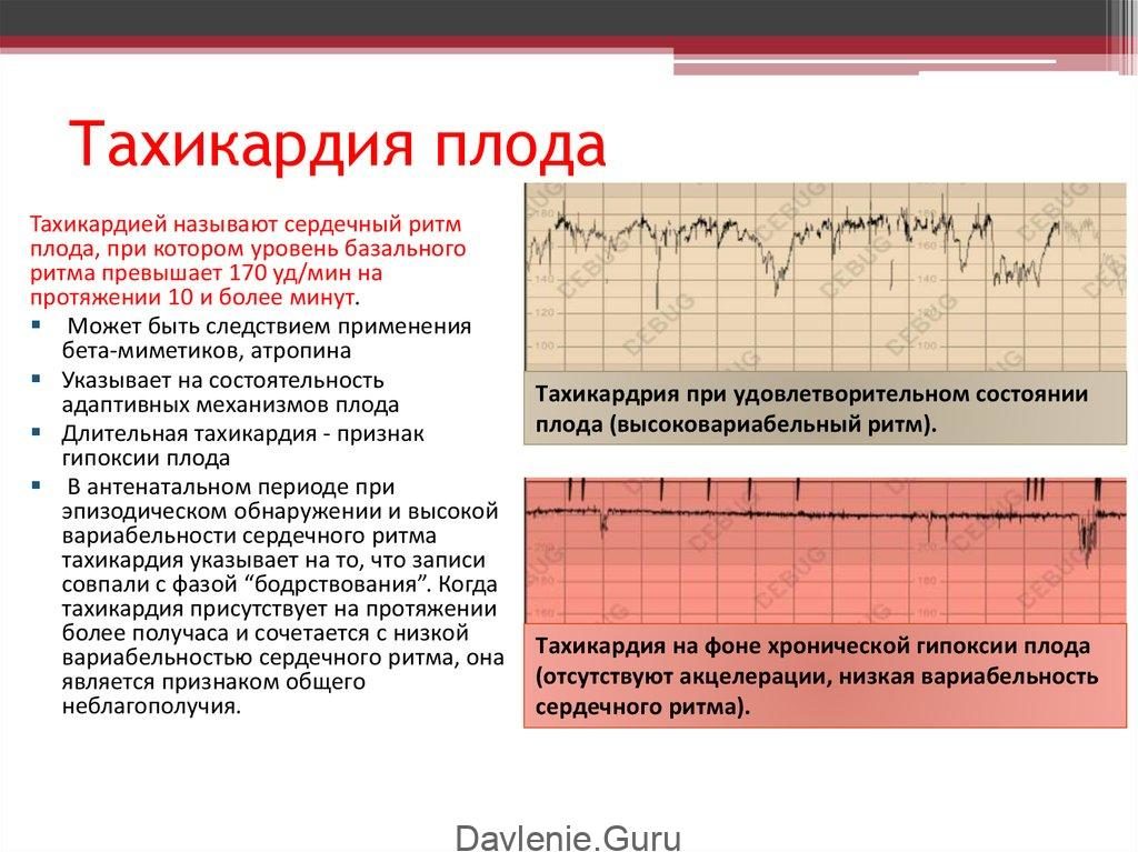 Тахикардия у плода на 35 неделе беременности