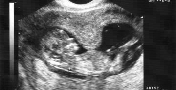14 недель беременности тонус матки