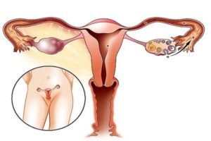 Болезненная овуляция причины