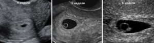 4 эмбриональная неделя беременности узи