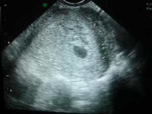 Снимок узи на 3 неделе беременности