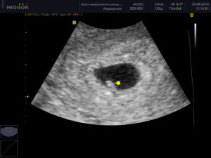 Как делают узи на 5 неделе беременности