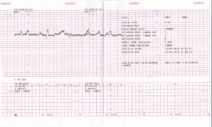 Плохое ктг при беременности 37 недель