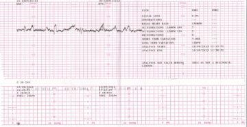 Плохое ктг при беременности 37 недель
