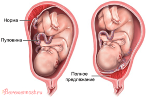 Низкое расположение плаценты при беременности 12 недель
