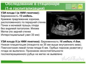 Центральное предлежание хориона на 13 неделе беременности