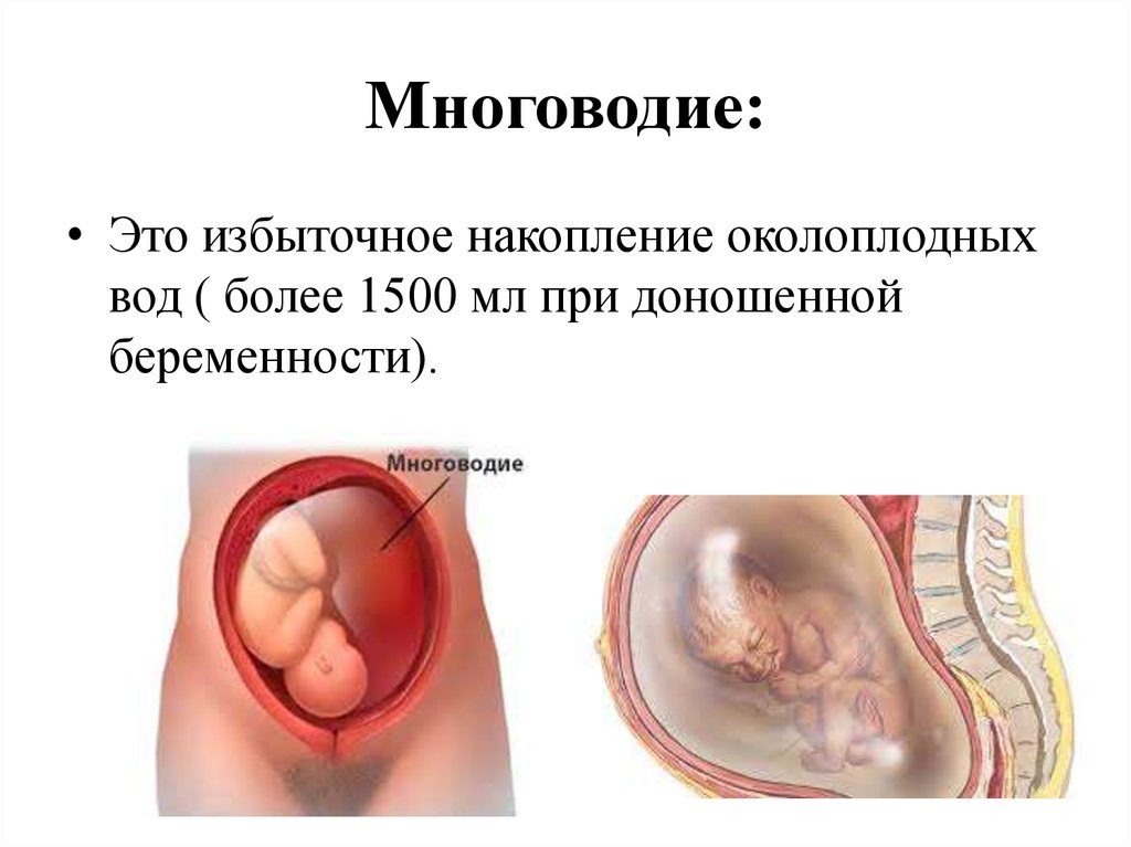 Чем опасно многоводие при беременности 32 недели