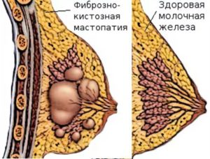 Уплотнение в молочной железе у кормящей мамы