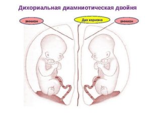 Двойня дихориальная диамниотическая 31 неделя беременности